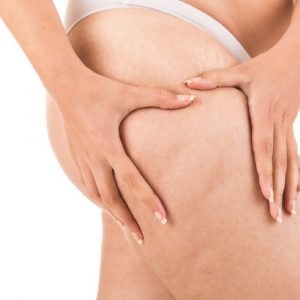 tratamiento celulitis